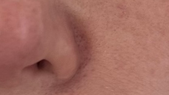 Før-billede microneedling hos Fyrsterling Clinic