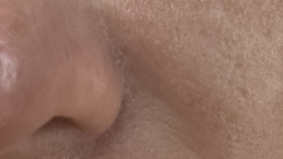 Efter-billede microneedling hos Fyrsterling Clinic