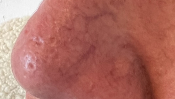 Før billede af næse inden microneedling behandling hos Fyrsterling Clinic