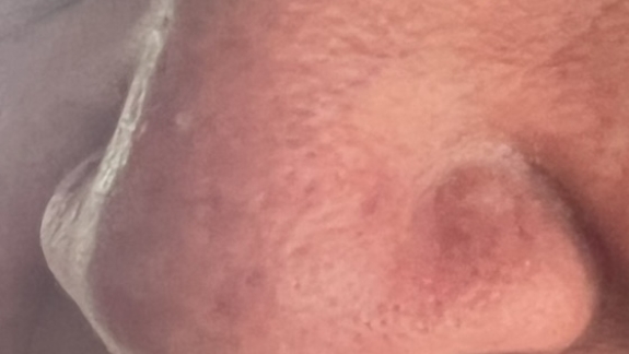 Før billede af næse inden microneedling behandling hos Fyrsterling Clinic