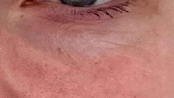 Behandling med fraktioneret CO2 laser hos Fyrsterling Clinic på Fyn