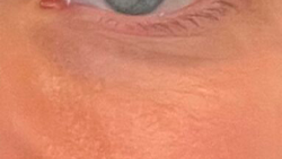 Behandling med fraktioneret CO2 laser hos Fyrsterling Clinic på Fyn