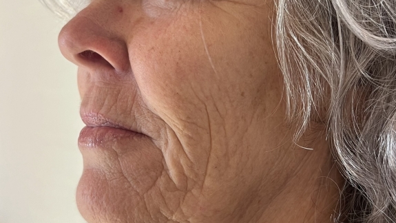 Før-billede med Restylane skinbooster hos Fyrsterling Clinic