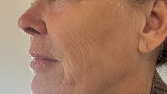 Efter-billede med Restylane skinbooster hos Fyrsterling Clinic