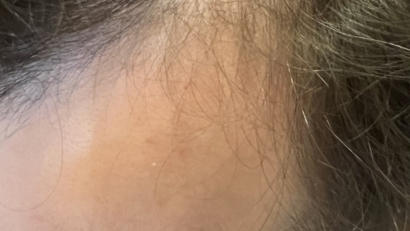 Behandling mod hårtab hos kosmetisk klinik Fyrsterling Clinic på Fyn