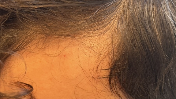 Behandling mod hårtab hos kosmetisk klinik Fyrsterling Clinic på Fyn