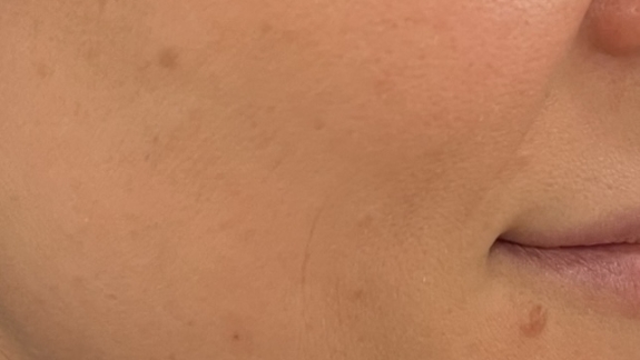 Efter-billede microneedling hos Fyrsterling Clinic