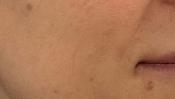 Før-billede microneedling hos Fyrsterling Clinic