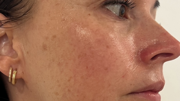 Skinbooster behandling udført af kosmetisk klinik på Fyn