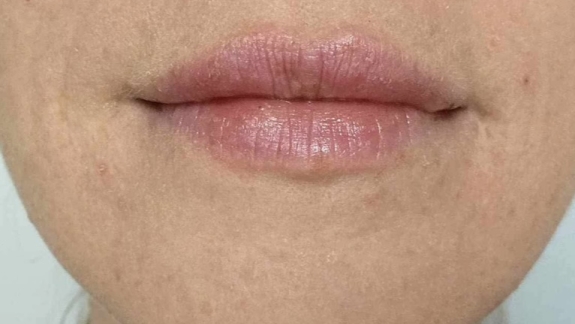 Efter kunde hos Fyrsterling Clinic i Odense har fået injiceret ikke-permanent filler i læberne