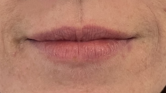 Før kunde hos Fyrsterling Clinic i Odense har fået injiceret ikke-permanent filler i læberne