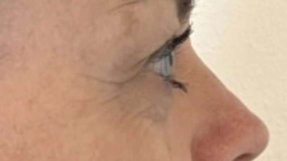 Før botox i bekymringsrynken og kragetæerne udført på Fyn