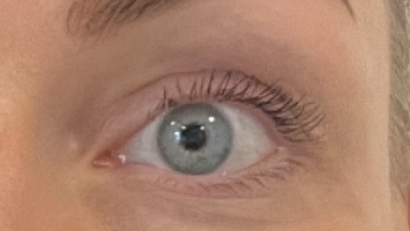 Efter Botox i bekymringsrynken, kragetæer samt brynløft udført af Fyrsterling Clinic