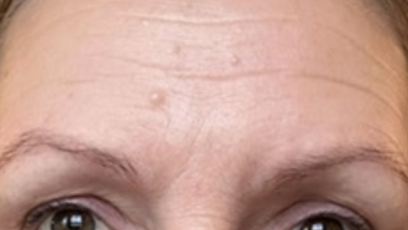 Før botox i panden udført af Fyrsterling Clinic i Odense på Fyn