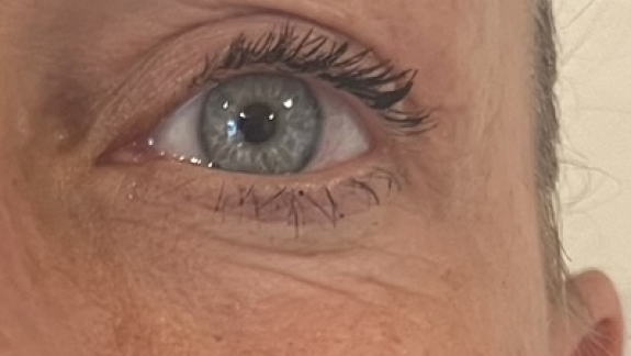 Efter ikke-permanent filler under øjnene hos Fyrsterling Clinic i Odense