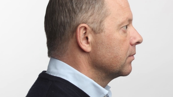 Efter ikke-permanent fillers i kæbelinje udført af Fyrsterling Clinic på Fyn