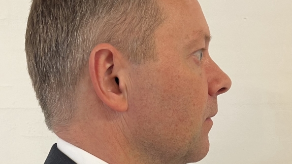 Før ikke-permanent fillers i kæbelinje udført af Fyrsterling Clinic på Fyn