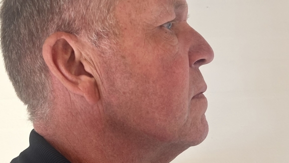 efter denne kunde har fået ikke-permanent filler i kæbevinkel og kæbelinje. 