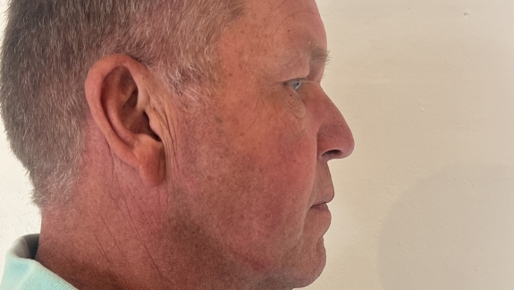 før denne kunde har fået ikke-permanent filler i kæbevinkel og kæbelinje. 