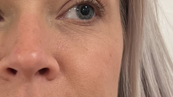 Efter ikke permanent filler i sin midtkind og tåretrug