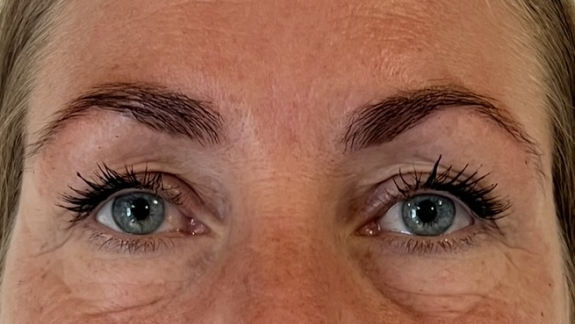 Efter-billede af botox behandling til bekymringsrynke, brynløft og kragetæer