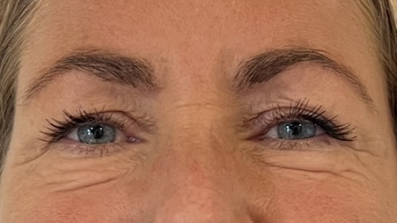 Før-billede af botox behandling til bekymringsrynke, brynløft og kragetæer