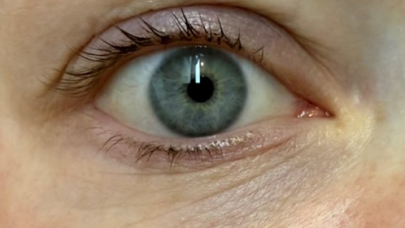 PRF behandling hos Fyrsterling Clinic i Odense på Fyn nær Svendborg