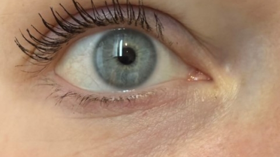 PRF behandling hos Fyrsterling Clinic i Odense på Fyn nær Svendborg