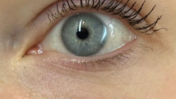 PRF behandling hos Fyrsterling Clinic i Odense på Fyn nær Svendborg