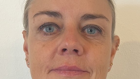 Billede af kvinde efter botox i panden, bekymringsrynken, kragetæer, nedadvendte mundvige samt nefertitisløft