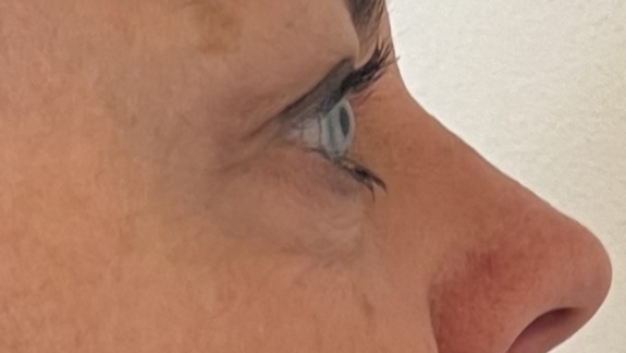 Botox behandling på kunde hos Fyrsterling Clinic