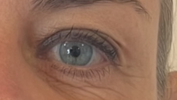 Botox behandling på kunde hos Fyrsterling Clinic