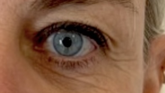 Botox behandling på kunde hos Fyrsterling Clinic