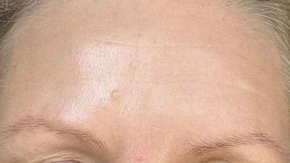 Efter-billede botox pande