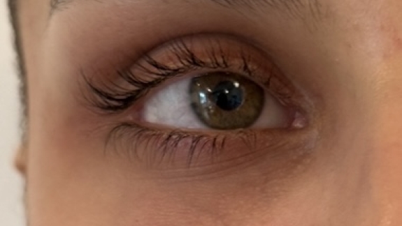 Efter kunden har fået injiceret ikke-permanent filler i tåretrugen – udført i Odense