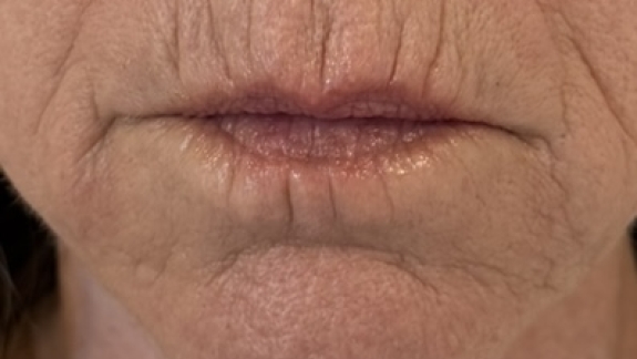 Efter ikke-permanent filler i mundvigen