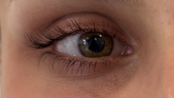 Før kunden har fået injiceret ikke-permanent filler i tåretrugen – udført i Odense