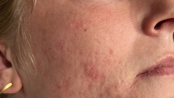 Behandling af akne ar hos professionel klinik i Odense på Fyn