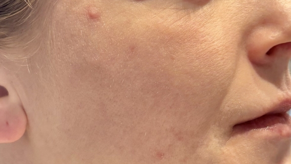 Behandling af akne ar hos professionel klinik i Odense på Fyn