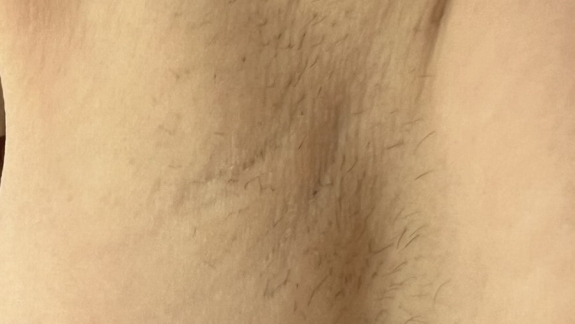 IPL permanent hårfjerning i kosmetisk klinik i Odense på Fyn