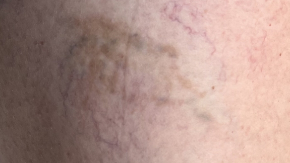 Fjern karsprængninger på ben hos Fyrsterling Clinic