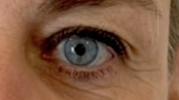 Før botox til brynløft udført af Fyrsterling Clinic i Odense