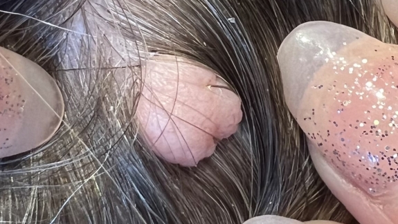 Fjernelse af gevækst på hud hos Fyrsterling Clinic