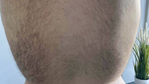 IPL permanent hårfjerning Fyrsterling Clinic før