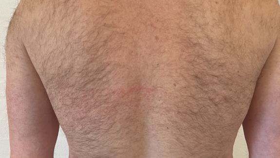 IPL permanent hårfjerning ryg før