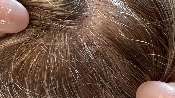 Fjernelse af gevækst på hud hos Fyrsterling Clinic