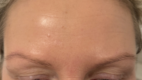 Fjernelse af gevækst på hud hos Fyrsterling Clinic