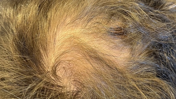 Før-billede inden PRP behandling mod hårtab