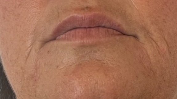 ZO Skin Health protokol lavet hos Fyrsterling Clinic på Fyn nær Svendborg