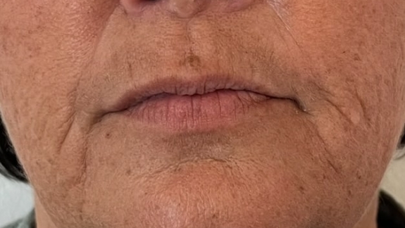 ZO Skin Health protokol lavet hos Fyrsterling Clinic på Fyn nær Svendborg